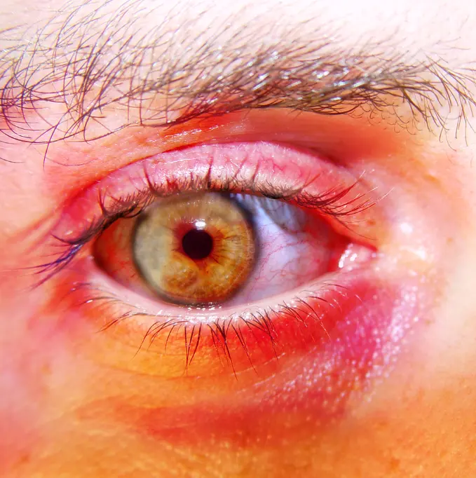 What is Stevens-Johnson Syndrome (SJS)?