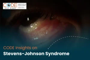 Stevens–Johnson Syndrome (SJS)
