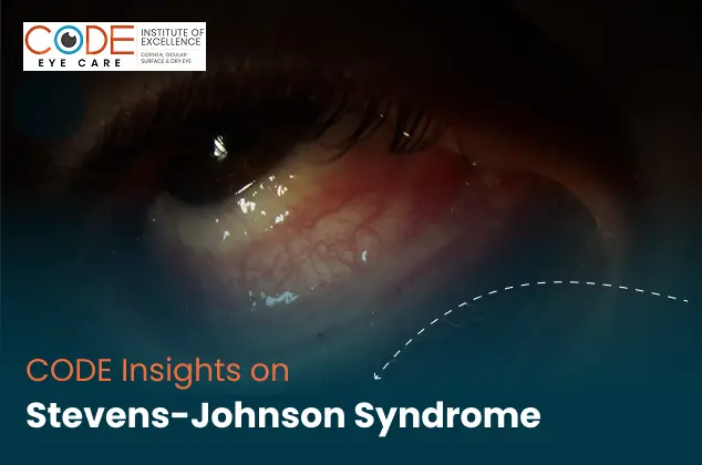 Stevens–Johnson Syndrome (SJS)