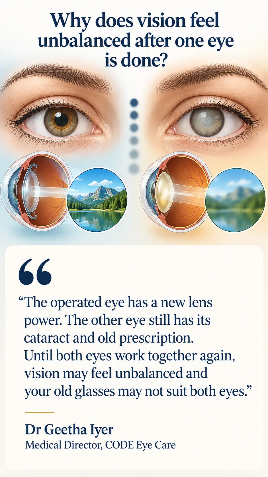 Illustration showing unbalanced vision after cataract surgery in one eye, with different lens powers and blurred vision in the untreated eye
